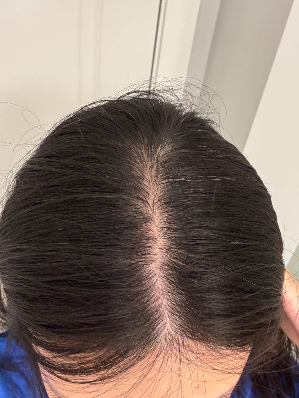 Before treatment - hair thinning