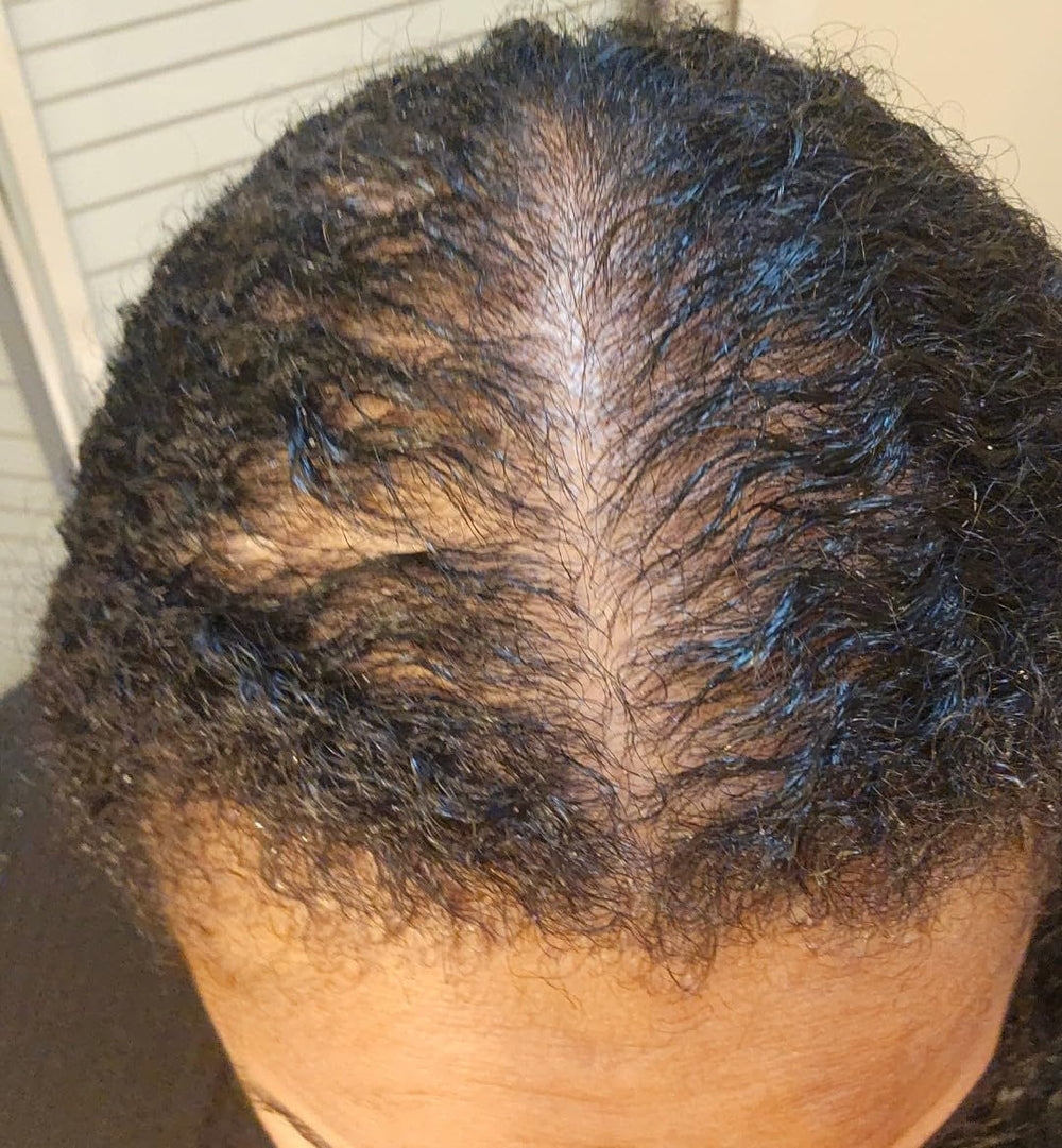 Before treatment - receding hairline