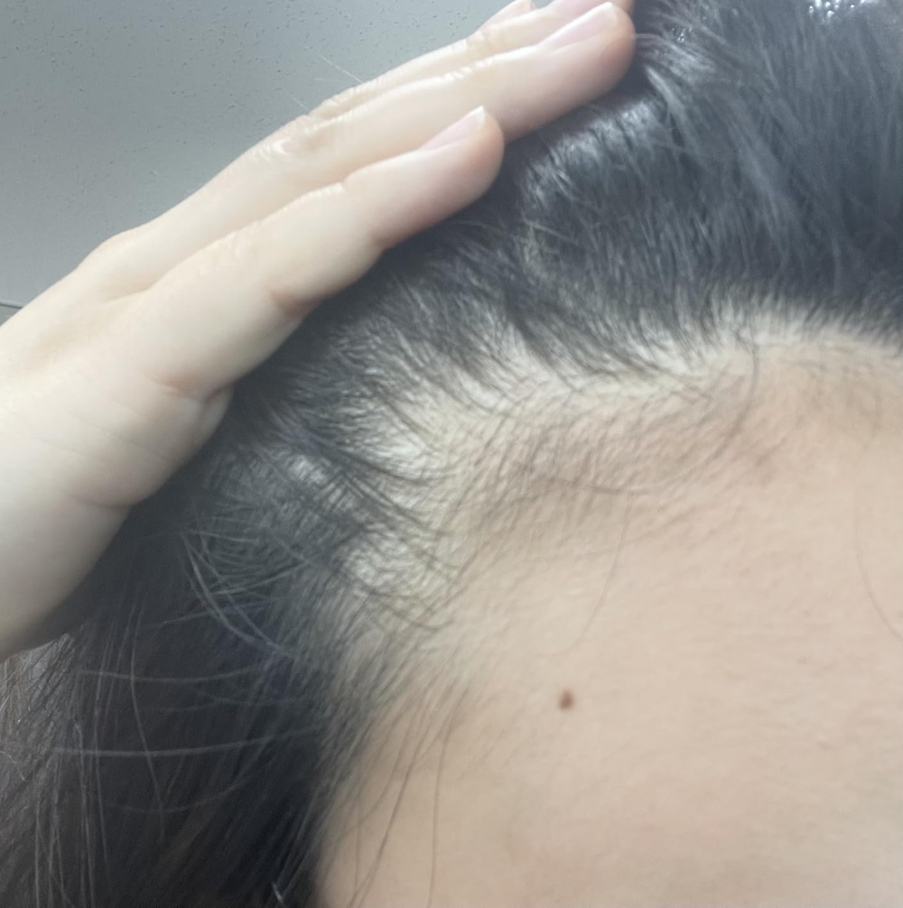 Before treatment - patchy areas